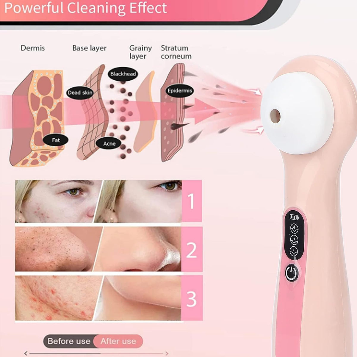 Aparat facial cu vacuum, extragere cosuri cu vizor pentru acnee si puncte negre